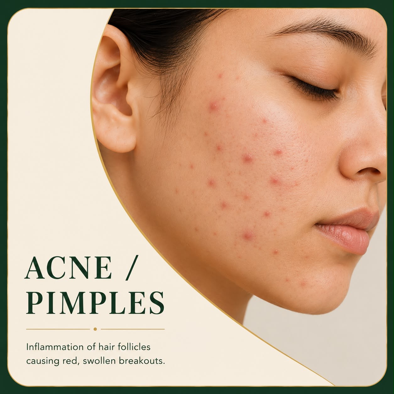 Acne and pimples affecting facial skin — Skin Ethos Clinic