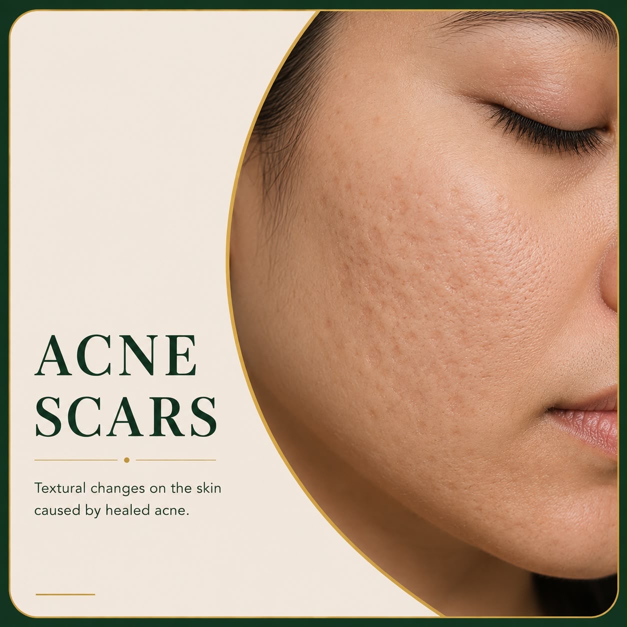 Textural acne scars on facial skin — Skin Ethos Clinic