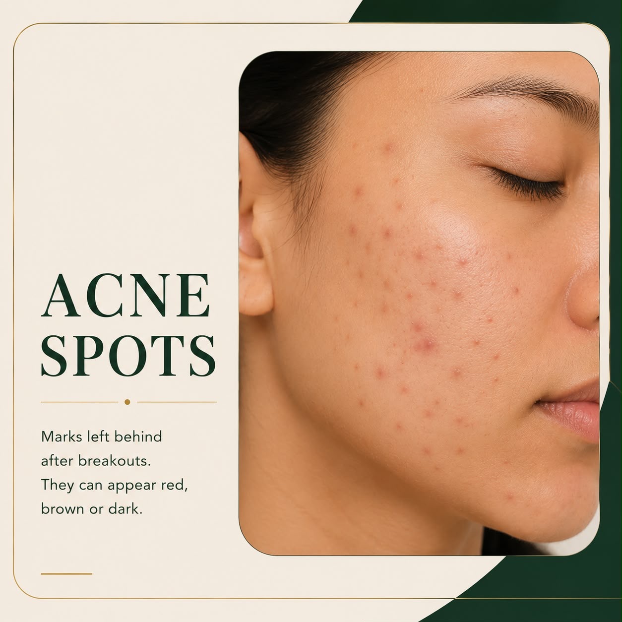 Post-acne spots and pigmentation on facial skin — Skin Ethos Clinic