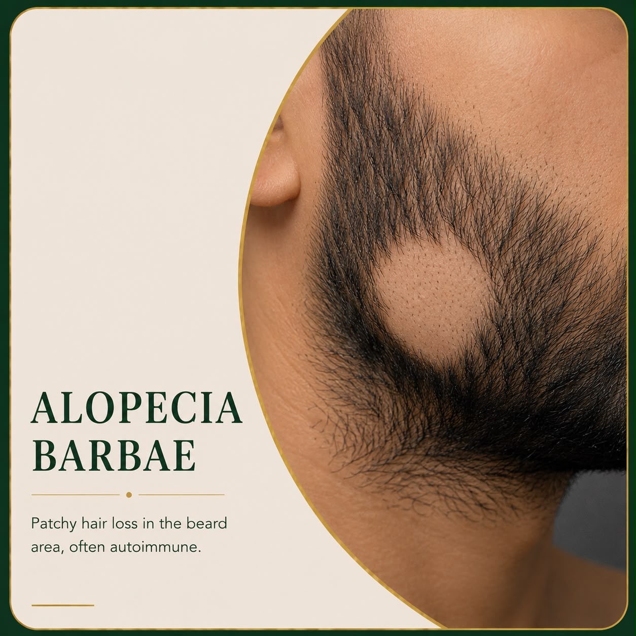 Alopecia barbae patchy beard hair loss — Skin Ethos Clinic