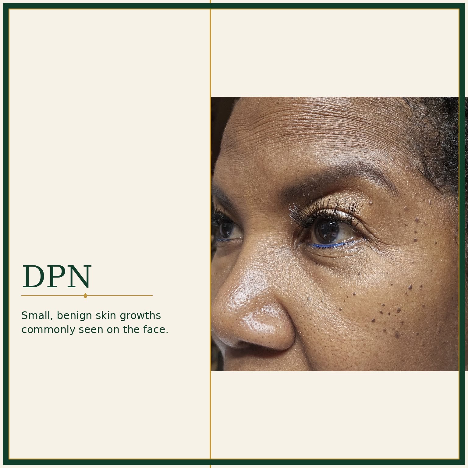 Dermatosis Papulosa Nigra skin growths — Skin Ethos Clinic
