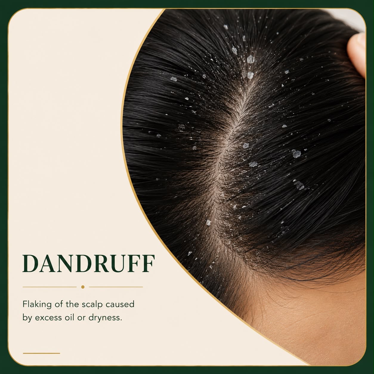 Dandruff and scalp flaking condition — Skin Ethos Clinic