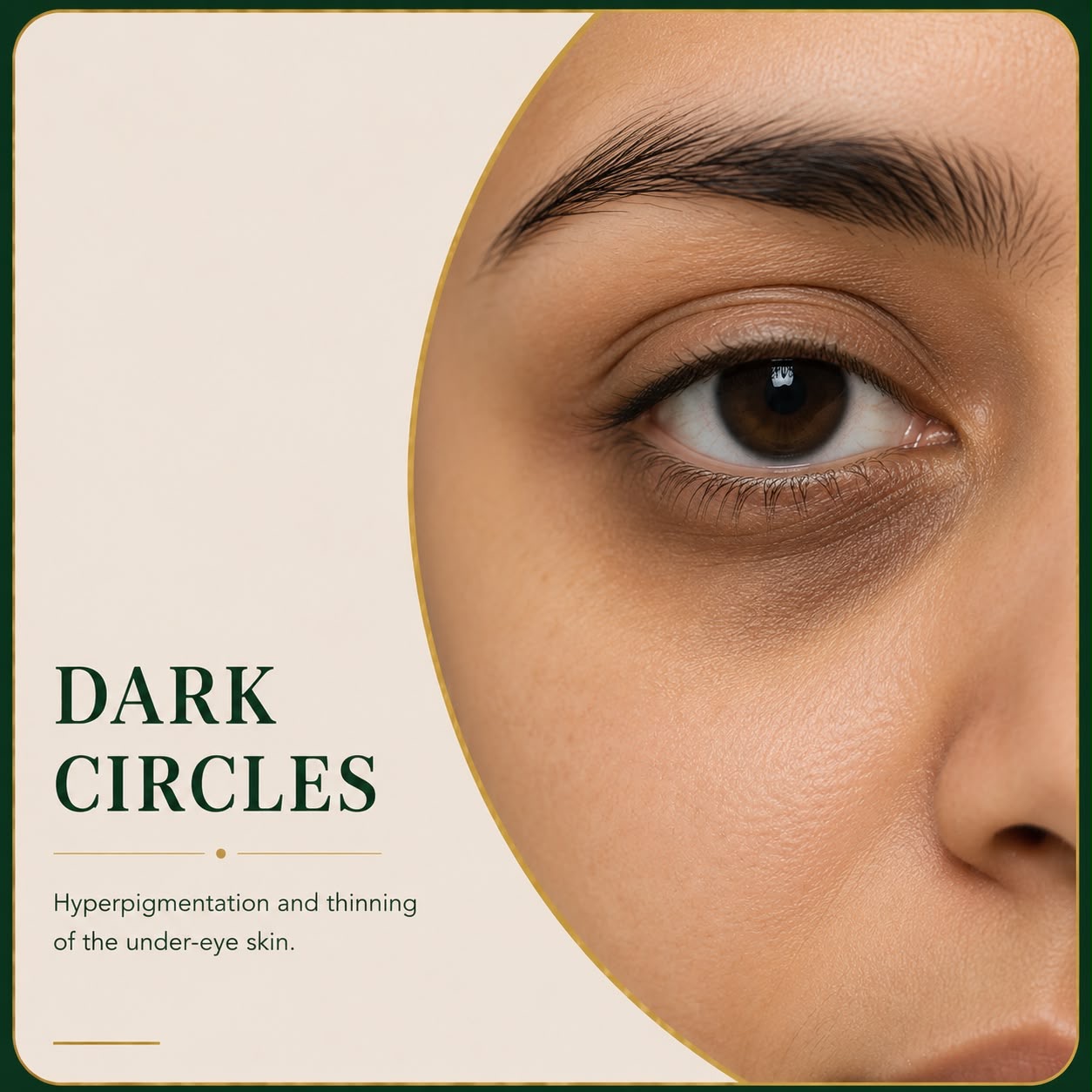 Dark circles and periorbital pigmentation — Skin Ethos Clinic