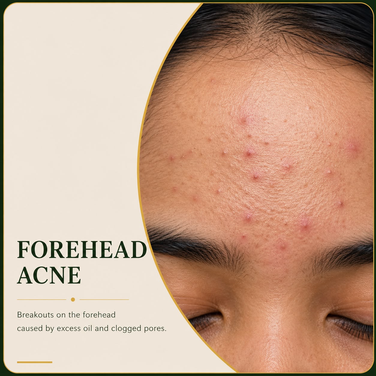 Forehead acne breakouts and bumps — Skin Ethos Clinic