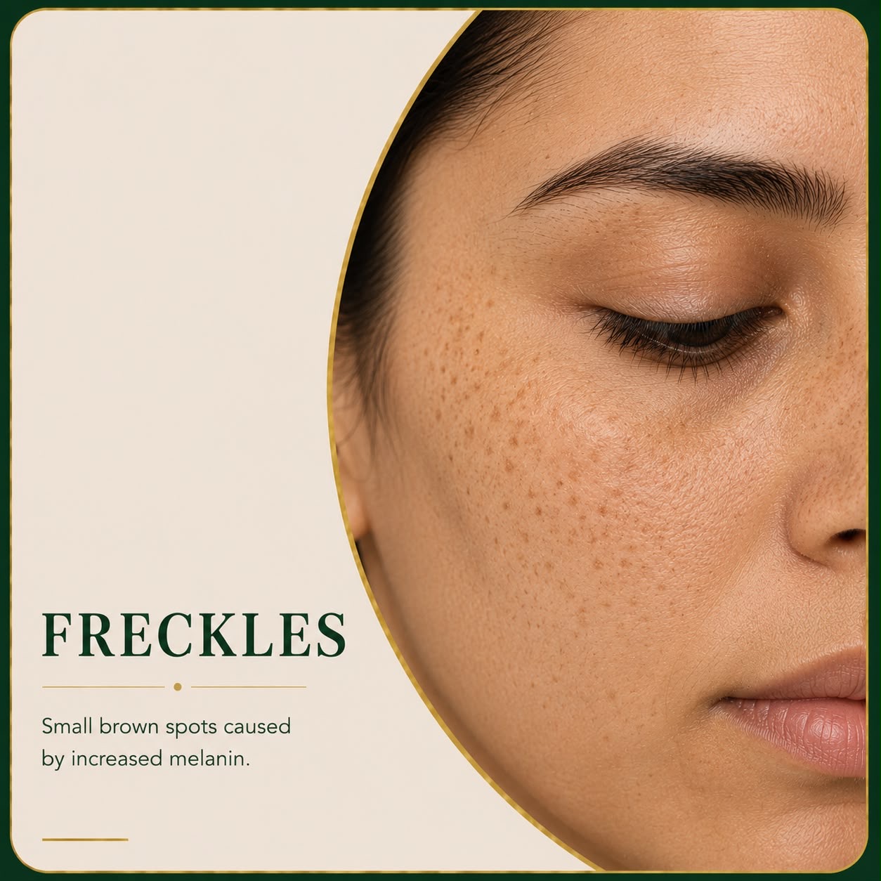 Freckles and sun-related pigmentation on facial skin — Skin Ethos Clinic