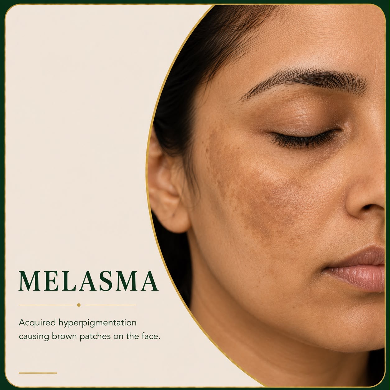 Melasma pigmentation on facial skin — Skin Ethos Clinic