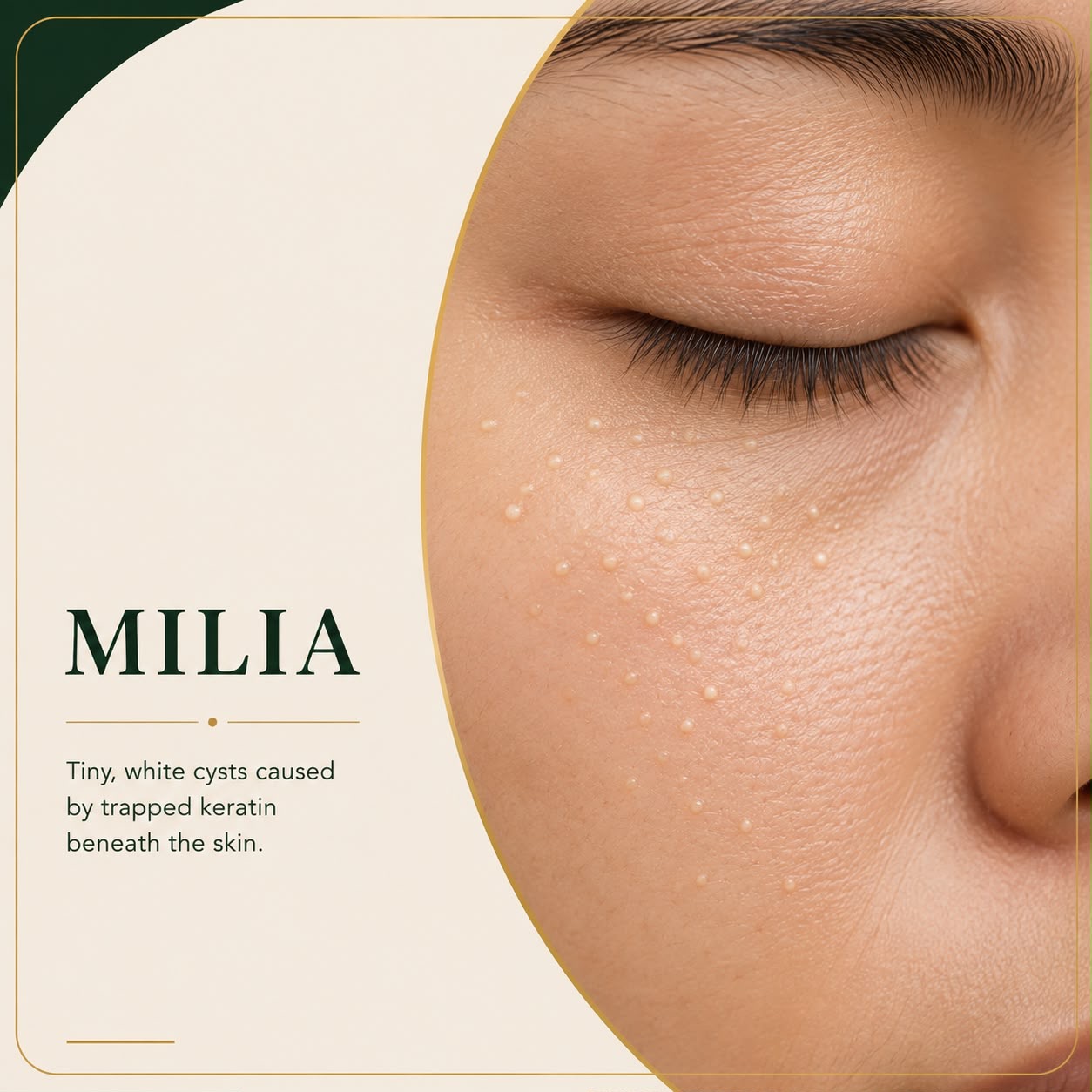 Milia white keratin cysts on facial skin — Skin Ethos Clinic