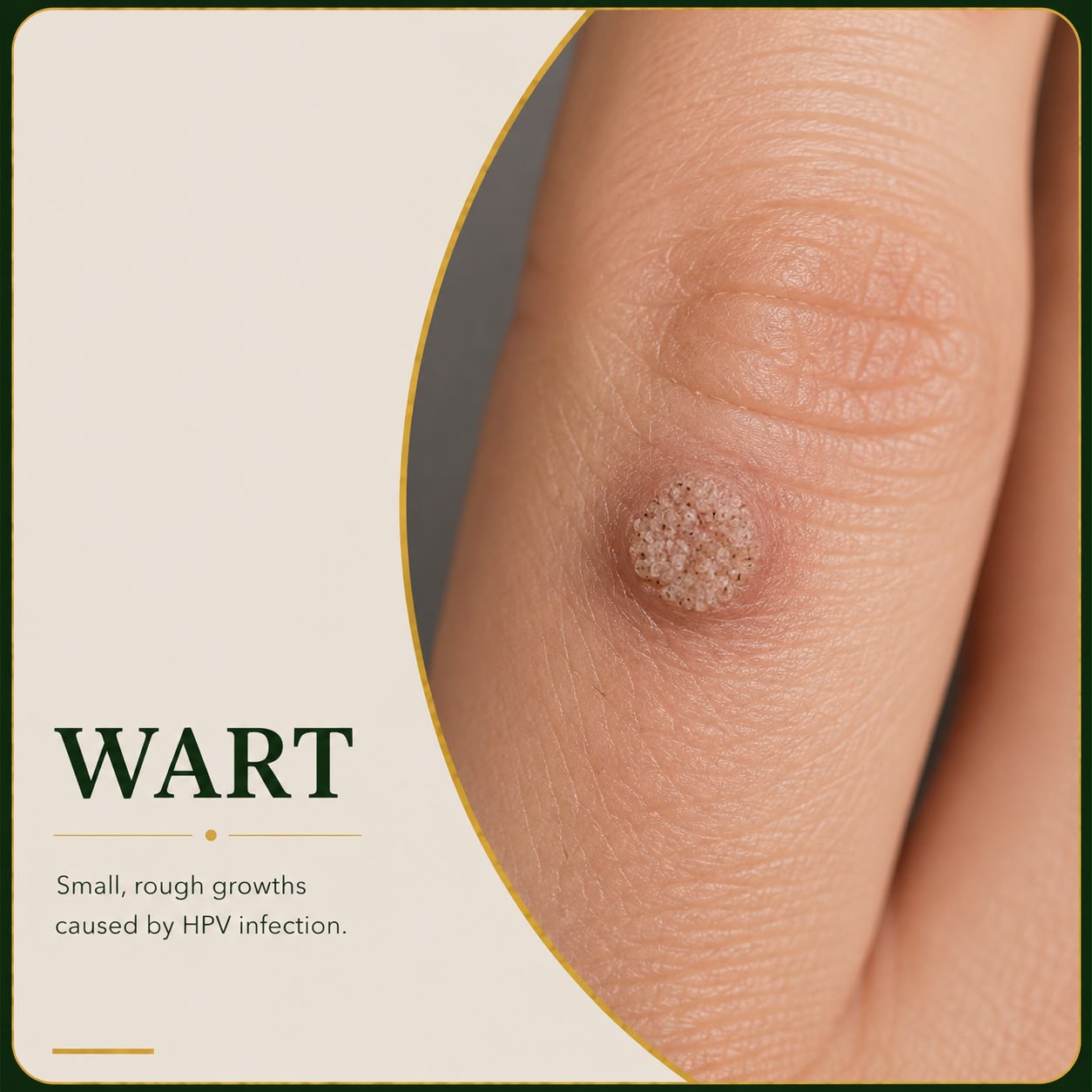Warts viral skin growths — Skin Ethos Clinic